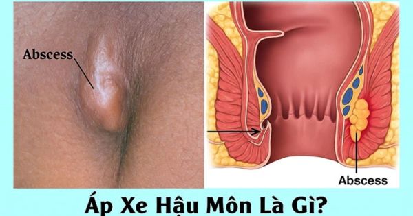 Hình ảnh áp xe hậu môn