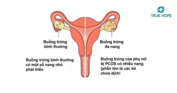 U nang buồng trứng