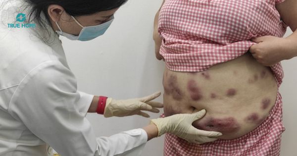 áp xe thành bụng do hút mỡ bụng
