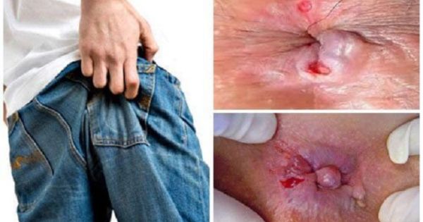 Hình ảnh thực tế vết áp xe hậu môn