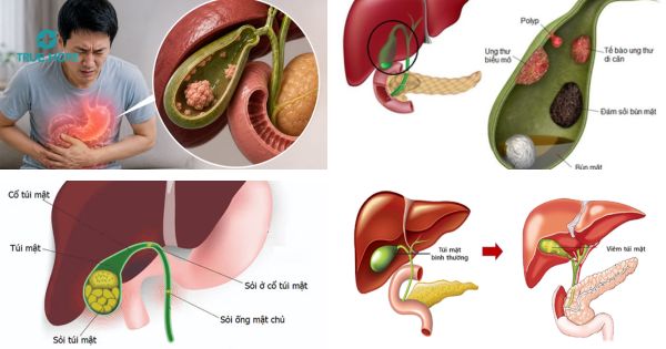 Phân biệt u cơ tuyến túi mật với polyp túi mật, sỏi túi mật và viêm túi mật