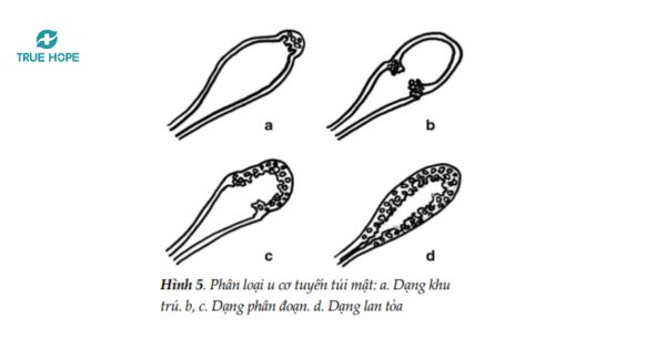 Các thể khu trú thường gặp