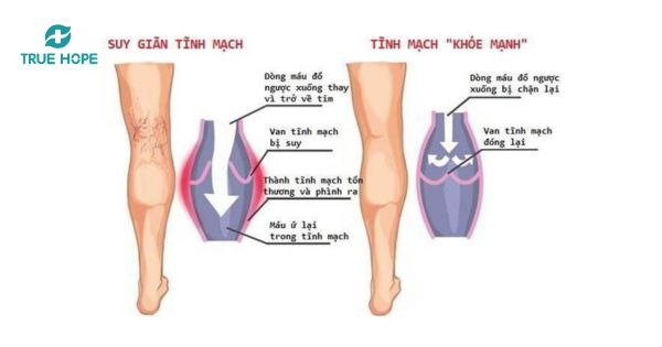 Giãn tĩnh mạch chi dưới