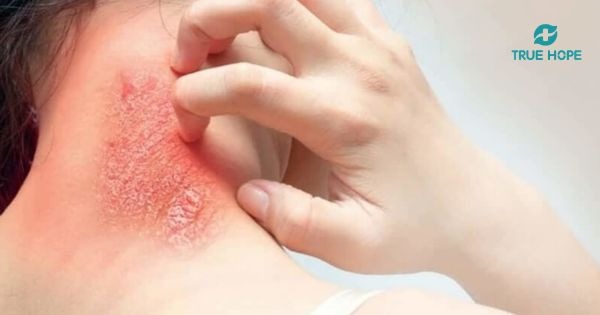 Nhiễm trùng phần mềm