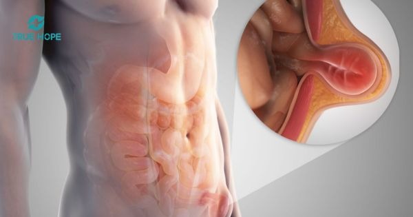 Thoát vị bẹn, thoát vị thành bụng