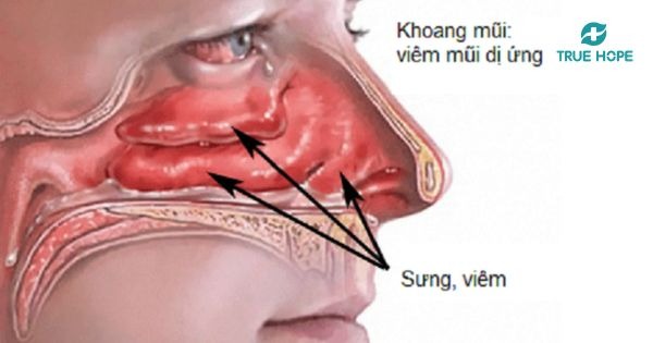 Viêm mũi dị ứng