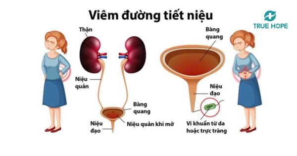 Tiết niệu