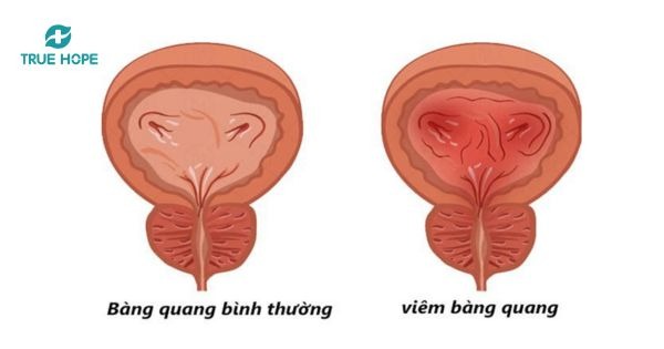 Viêm bàng quang