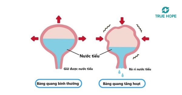 Tiểu són