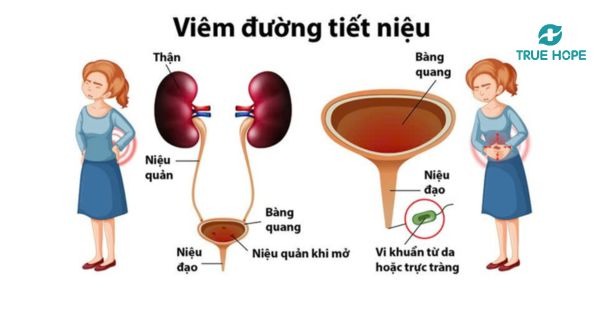 Nguyên nhân viêm đường tiết niệu