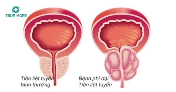 Tuyến tiền liệt
