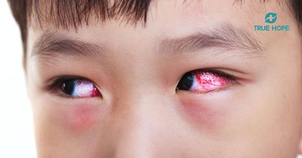 Bệnh đau mắt đỏ ở trẻ em