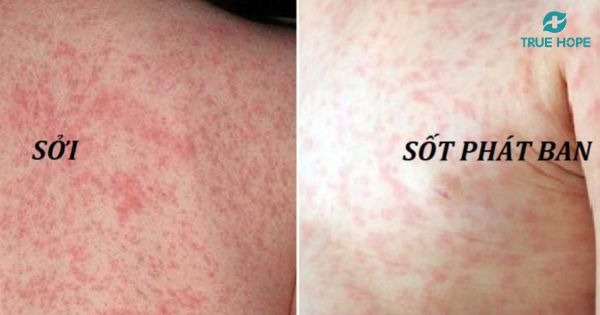 Sởi và sốt phát ban