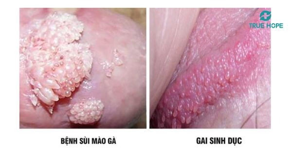 Sùi mào gà - bệnh lây qua đường tình dục