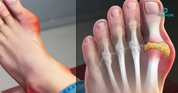 Hình ảnh 3D mô phỏng Gout
