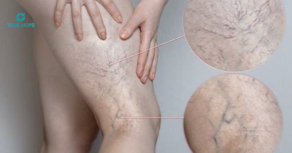 Hình ảnh suy giãn tĩnh mạch