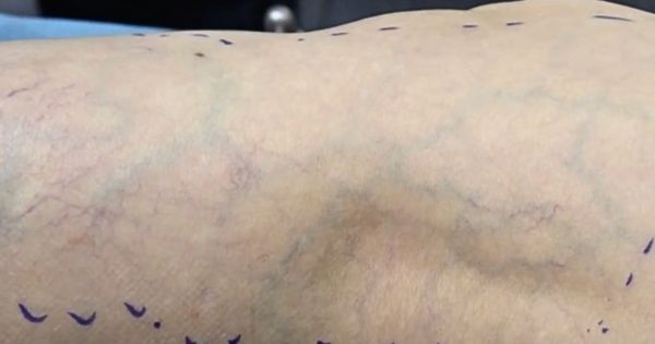 Hình ảnh giãn mao mạch và tĩnh mạch lộ rõ theo thời gian