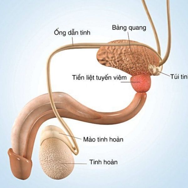 Hình ảnh 3D mô phỏng tuyến tiền liệt bị viêm