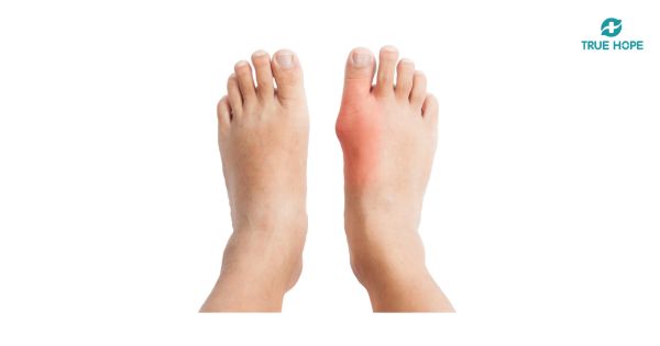 Chân sưng đỏ do cơn gout cấp liên quan acid uric
