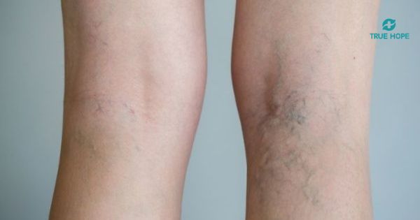 Dấu hiệu suy giãn tĩnh mạch chi dưới mạch máu nổi rõ dưới da chân