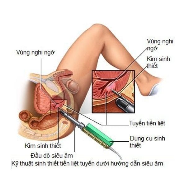 Kỹ thuật sinh thiết tiền liệt tuyến để kiểm tra chính xác bệnh