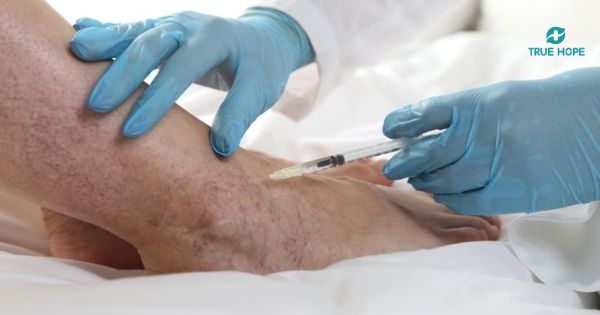 Tiêm xơ điều trị suy giãn tĩnh mạch chi dưới tại phòng khám