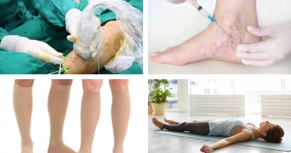 Các phương pháp điều trị giãn mao mạch và tĩnh mạch nhện tiêm xơ laser tất áp lực vận động