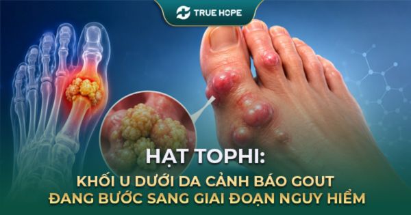 Hạt Tophi: Cảnh báo Gout bước sang giai đoạn nguy hiểm