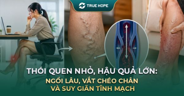 Ngồi lâu, vắt chéo chân: Thói quen nhỏ dẫn đến suy giãn tĩnh mạch