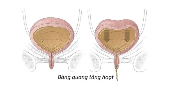 Hình ảnh so sánh bàng quang bình thường và bàng quang tăng hoạt ở phụ nữ