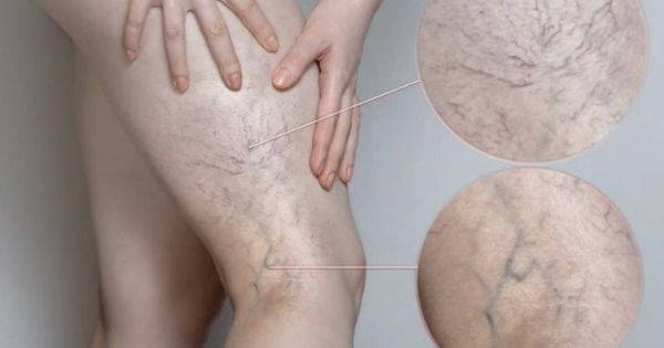 Đôi chân suy giãn tĩnh mạch cần chăm sóc đúng cách sau điều trị
