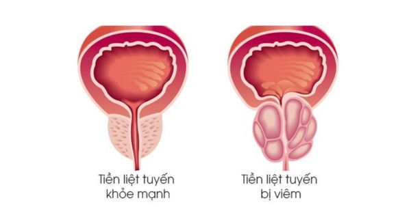 Viêm tuyến tiền liệt - so sánh tuyến tiền liệt bình thường và bị viêm