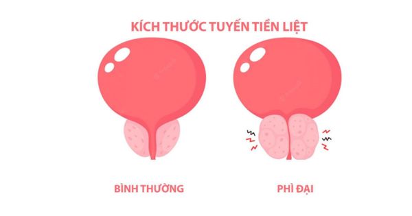Phì đại tuyến tiền liệt - so sánh tuyến tiền liệt bình thường và phì đại