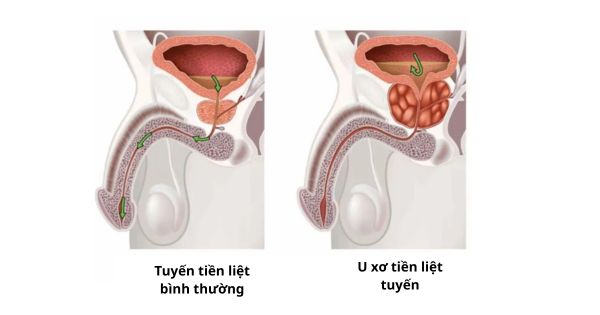 U xơ tuyến tiền liệt - so sánh tuyến tiền liệt bình thường và u xơ tuyến tiền liệt 3D