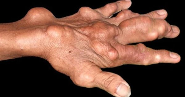 Hình ảnh những hạt tophi được chụp lại trên tay của người đàn ông