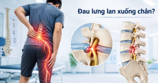 Đau lưng lan xuống chân dấu hiệu thoát vị đĩa đệm chèn ép rễ thần kinh