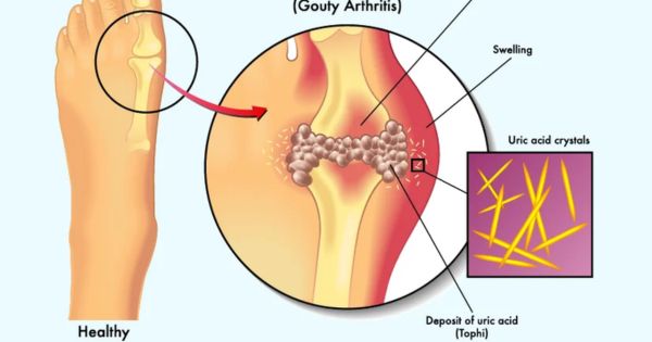 Hình ảnh minh họa tinh thể Acid uric tích tụ ở khớp chân