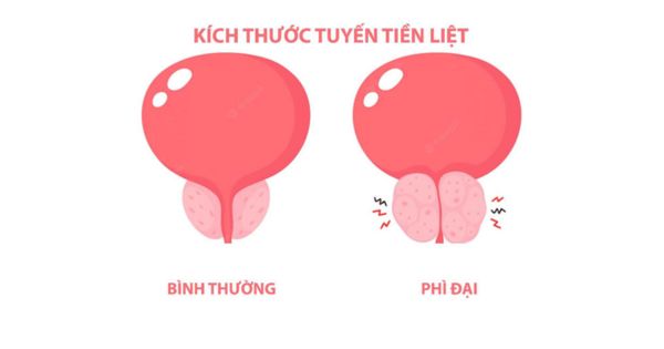 Hình ảnh so sánh tuyến tiền liệt bình thường và tuyến tiền liệt phì đại BPH