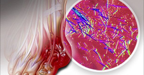 Acid uric cao gây lắng đọng tinh thể urate tại khớp trong bệnh gout