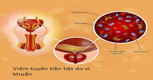 Nguyên nhân viêm tuyến tiền liệt do vi khuẩn - hình ảnh 3D