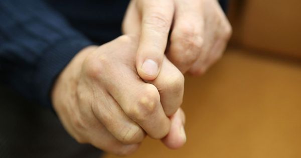 Hình ảnh hạt tophi xuất hiện ở khớp tay