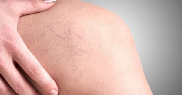 Hình ảnh suy giãn tĩnh mạch ở chân