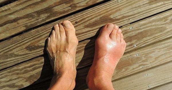 Người bệnh khó đi lại do gout ở bàn chân