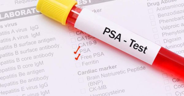 Xét nghiệm PSA tuyến tiền liệt - kháng nguyên đặc hiệu trong máu