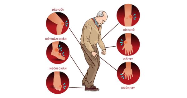 Một số vị trí thường gặp của hạt tophi