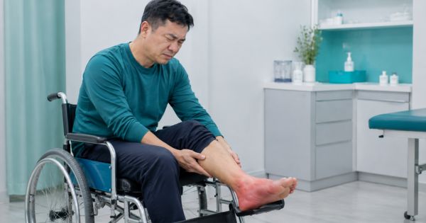 Chú H đến True Hope trong tình trạng bàn chân phù nề, đau buốt, không đi lại được