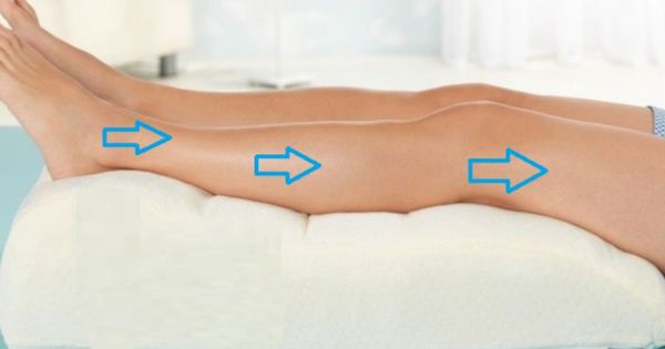 Nâng cao chân khi nghỉ ngơi giúp giảm phù sau điều trị tĩnh mạch