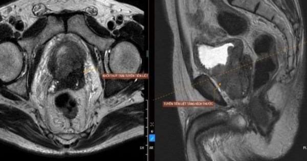MRI tuyến tiền liệt hỗ trợ chẩn đoán ung thư tuyến tiền liệt