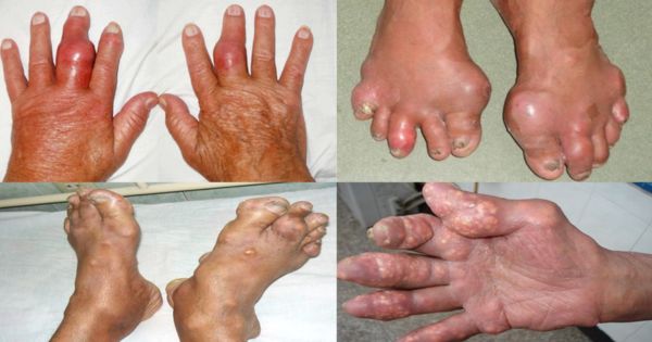 Hình ảnh gout đang trong giai đoạn tiến triển nặng