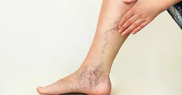 Điều trị suy giãn tĩnh mạch không chỉ vì thẩm mỹ mà còn cải thiện sức khỏe